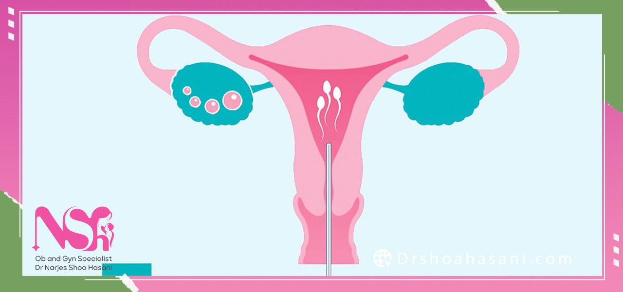 چه زمانی آی یو آی کاربرد دارد؟