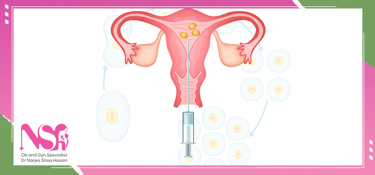 تعیین جنسیت با آی یو آی