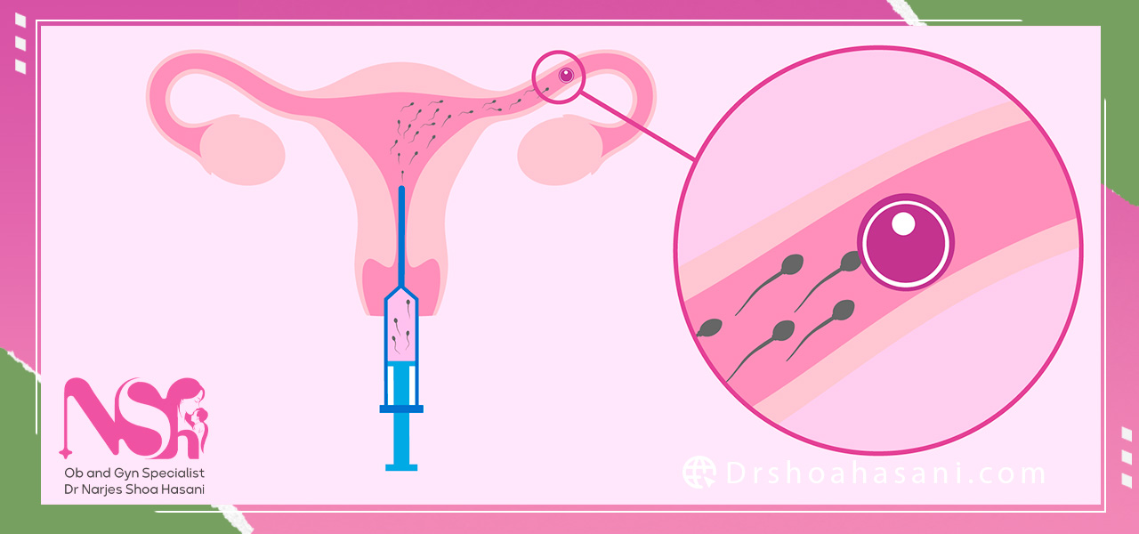 عوارض احتمالی آی یو آی